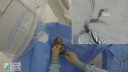 Google Glass use in a fistuloplasty